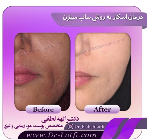 عکس صورت بعد از سابسیژن