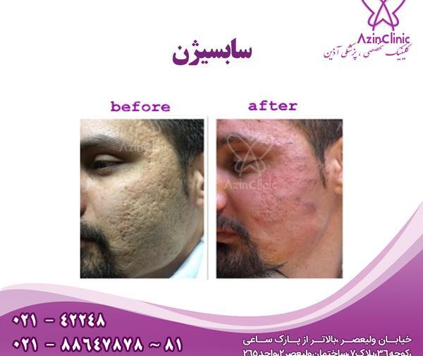 عکس صورت بعد از سابسیژن