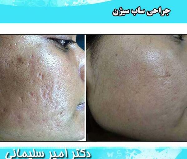 عکس صورت بعد از سابسیژن