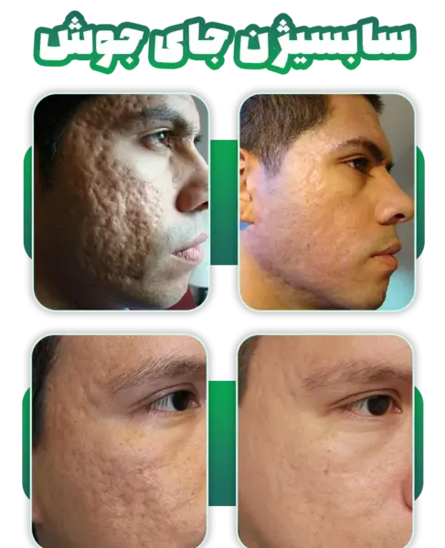 عکس صورت بعد از سابسیژن