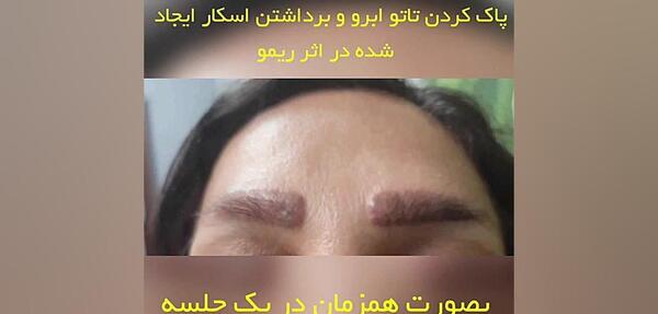 عکس تاتو ابرو پاک شده
