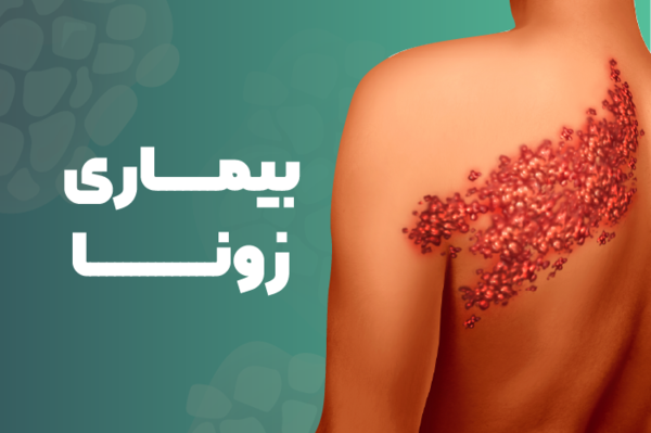عکس بیماری زونا در بزرگسالان