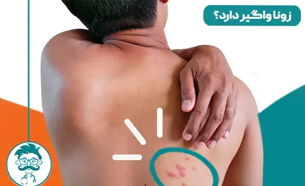 عکس بیماری زونا در بزرگسالان