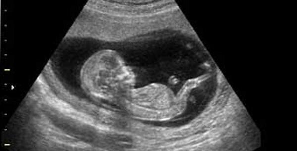 عکس بچه سقط شده سه ماهه