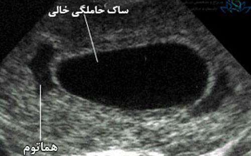 عکس بچه سقط شده ۶ هفته