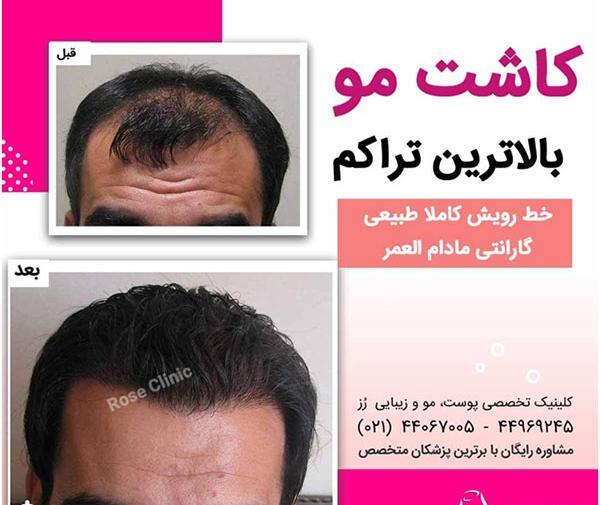 تعویض عکس پاسپورت بعد از کاشت مو