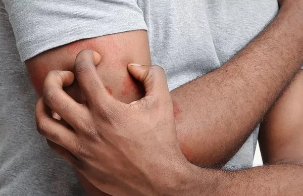 عکس بیماری گال روی پوست