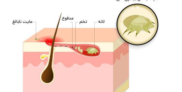 عکس عكس بيماري گال