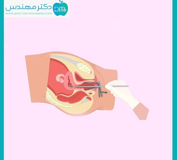 عکس بچه یک ماهه سقط شده