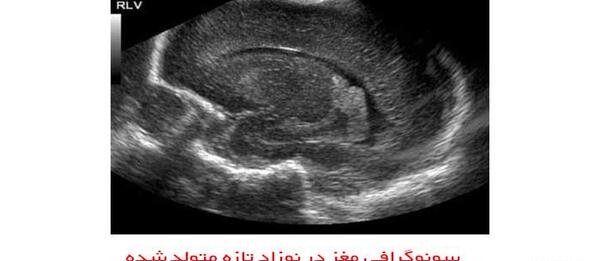 عکس سونوگرافی بچه یک ماهه