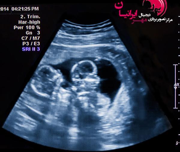 عکس سونوگرافی بچه یک ماهه