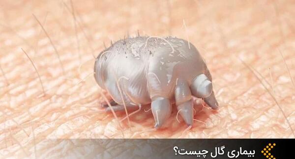 عکس بیماری گال نروژی