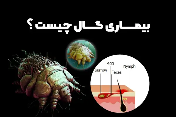 عکس بیماری گال نروژی