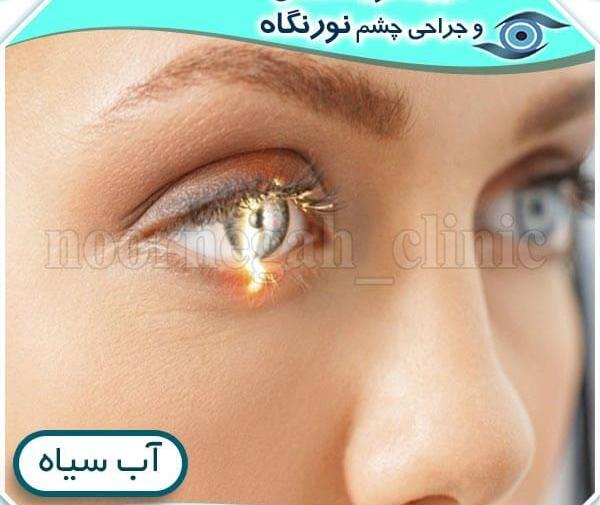 عکس چشمی که اب سیاه دارد