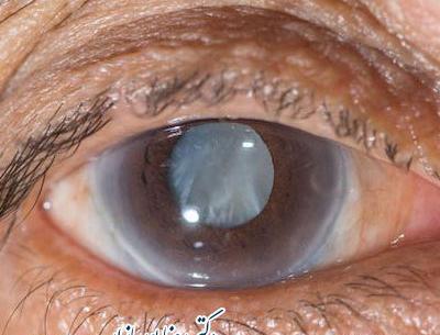 عکس چشمی که اب سیاه دارد