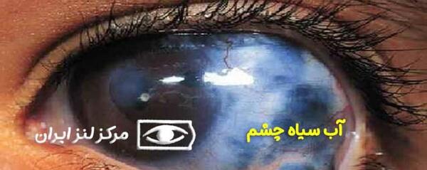 عکس چشمی که اب سیاه دارد
