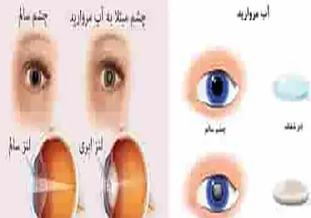 عکس برداری از چشم اهواز