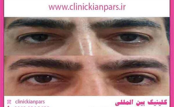 عکس برداری از چشم اهواز