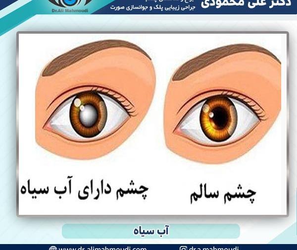 عکس چشم دارای اب سیاه