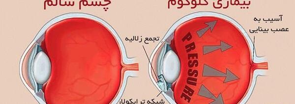 عکس چشم دارای اب سیاه