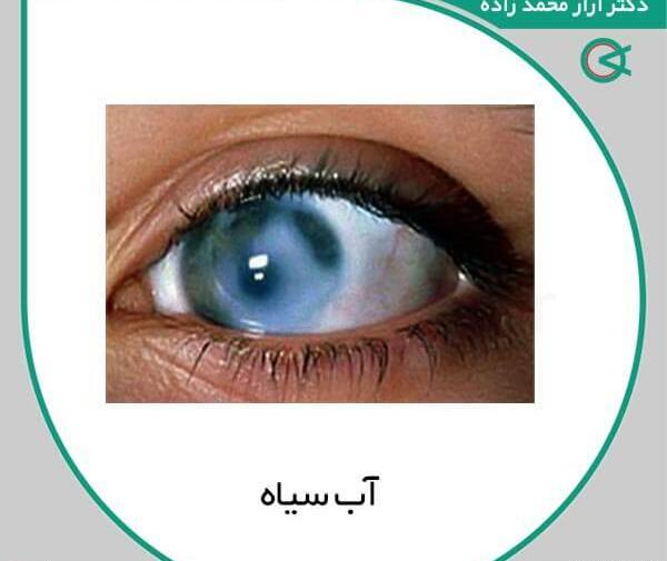 عکس چشم دارای اب سیاه