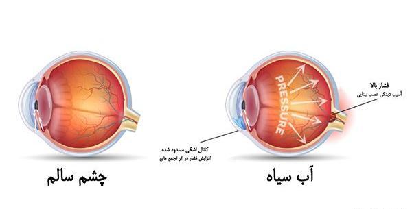 عکس چشم دارای اب سیاه