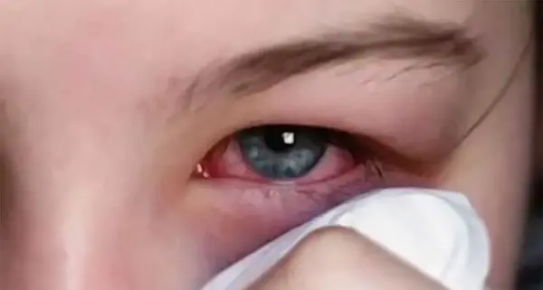عکس چشم دارای اب سیاه