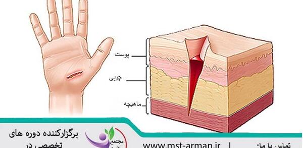 عکس هایی از سیاه زخم