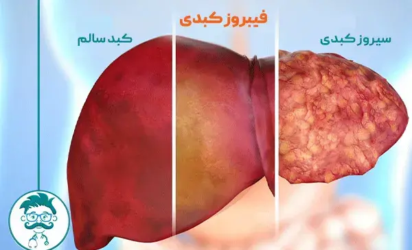 عکس سیاهرگ باب فوق کبدی