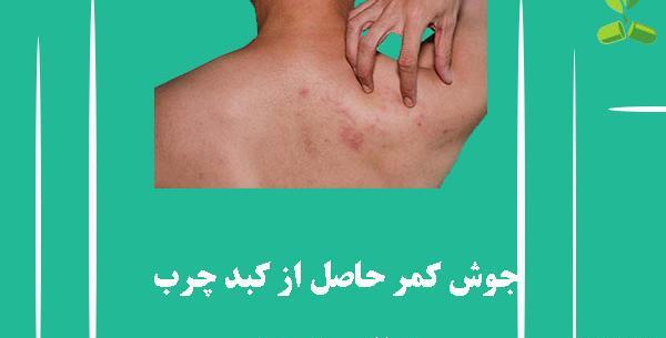 عکس لکه های کبدی