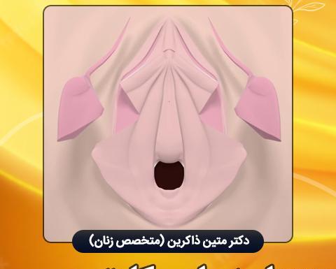 عکس های واقعی عمل لابیاپلاستی نی نی سایت