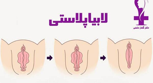 عکس های واقعی عمل لابیاپلاستی نی نی سایت