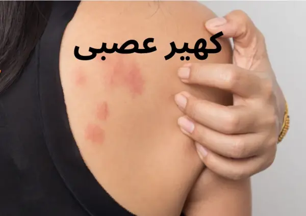 عکس حساسیت پوستی