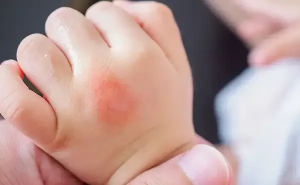 عکس حساسیت پوستی