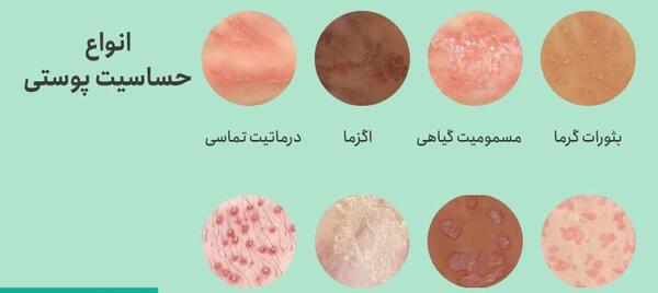 عکس حساسیت پوستی