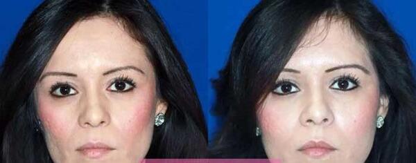 عکس های چاقی صورت