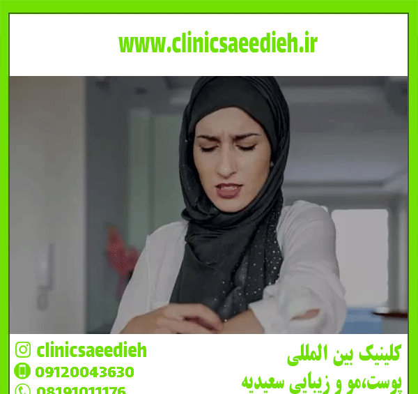 عکس انواع اگزما