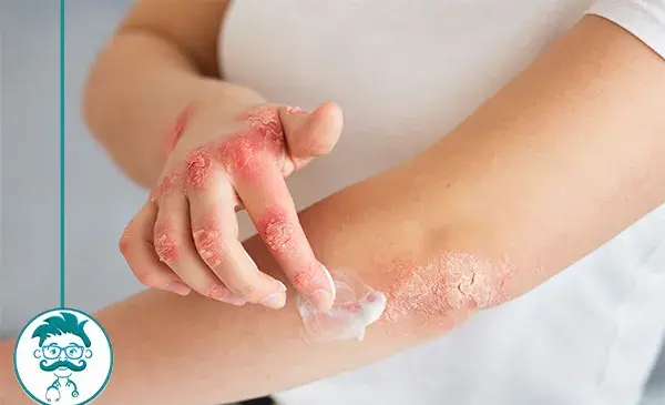 عکس انواع اگزما