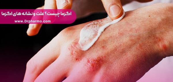 عکس انواع اگزما