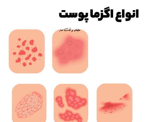 عکس انواع اگزما