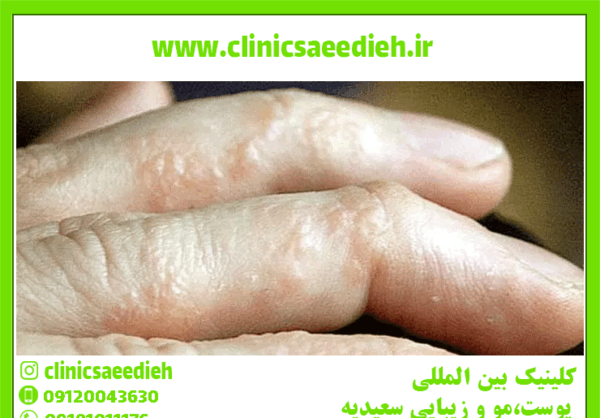 عکس انواع اگزما