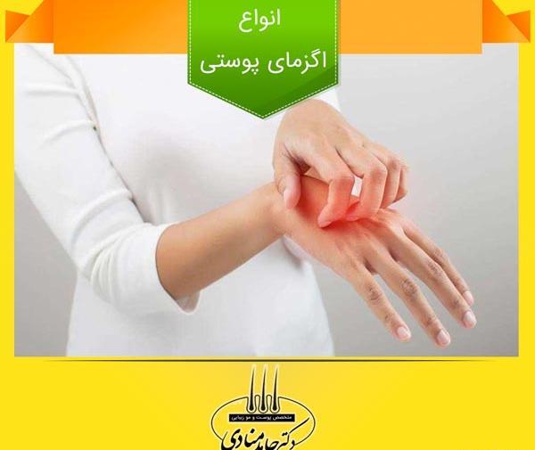 عکس انواع اگزما