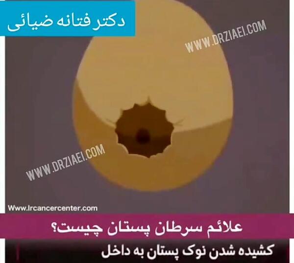 عکس سرطان سینه