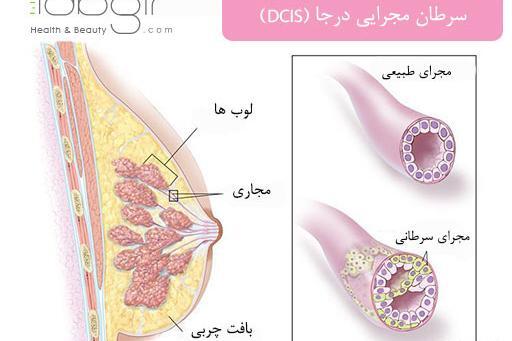 عکس سرطان سینه