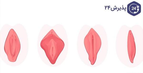 عکس های واقعی عمل لابیاپلاستی مشهد استان خراسان رضوی ایران