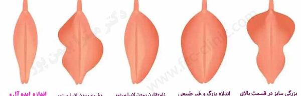 عکس های واقعی عمل لابیاپلاستی مشهد استان خراسان رضوی ایران