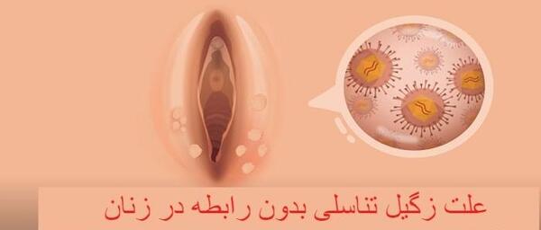 عکس واضح از زگیل تناسلی زنان نی نی سایت