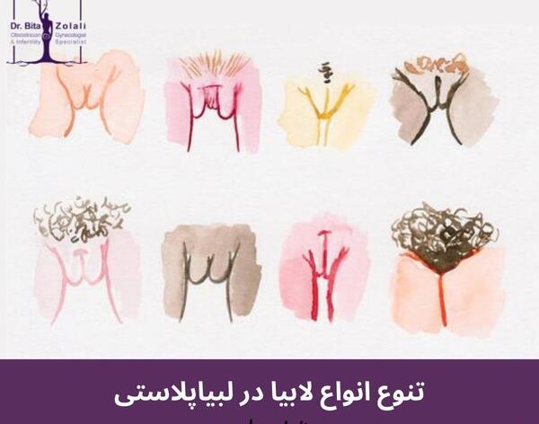 بخیه زیبایی عکس های واقعی عمل لابیاپلاستی