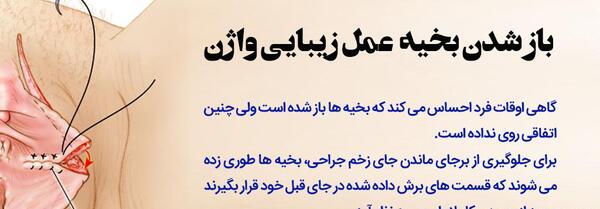بخیه زیبایی عکس های واقعی عمل لابیاپلاستی