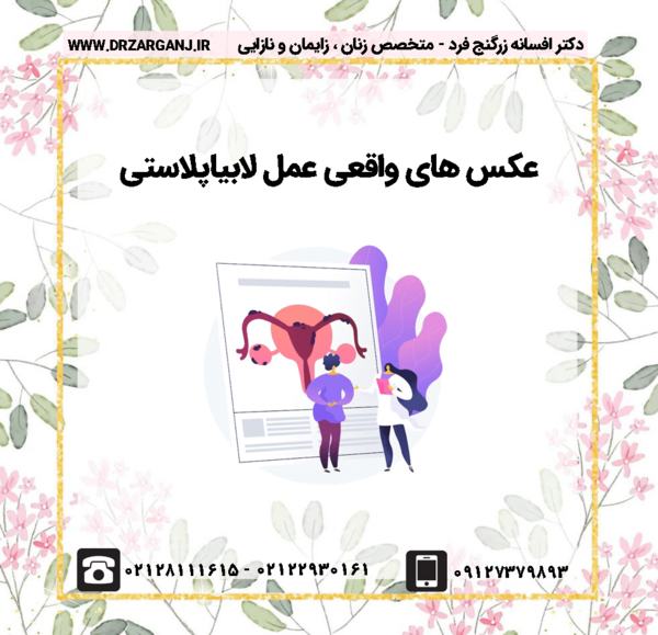 برداشتن لابيا عکس های واقعی عمل لابیاپلاستی